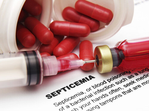 Причины сепсиса.