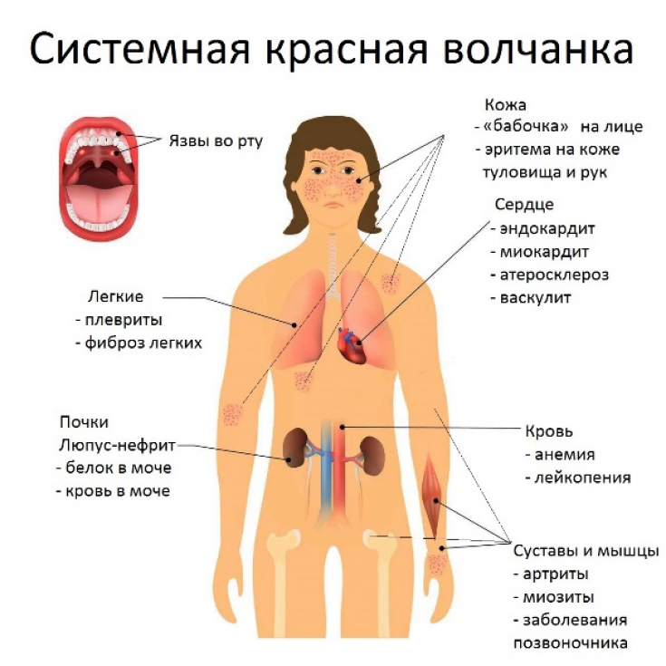 Система волчанка. Системная красная волчанка кожные симптомы. Система красной волчанки симптомы. Системная красная волчанка Люпус. Системная красная волчанка клинические рекомендации 2020