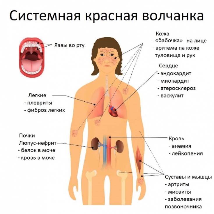 Симптомы волчанки диагностика