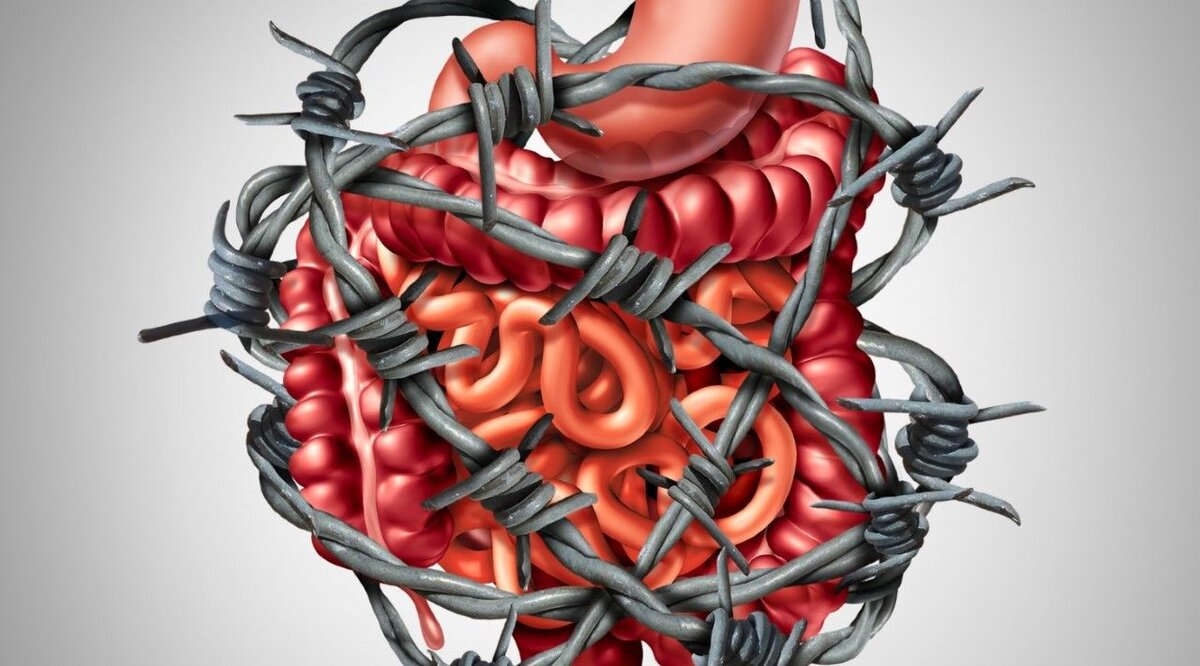 Что такое синдром раздраженного кишечника и как его лечить? Объясняет  психиатр | Клиника доктора Шурова | Дзен
