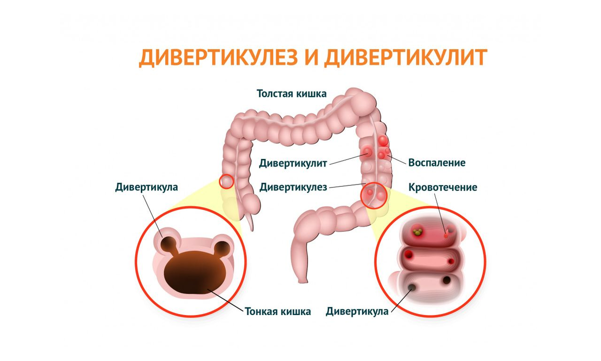 Дивертивертикулы сигмовидной кишки