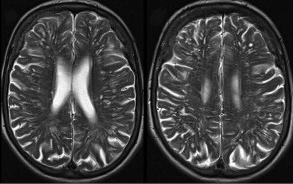Схема 'бабочки' в головном мозге