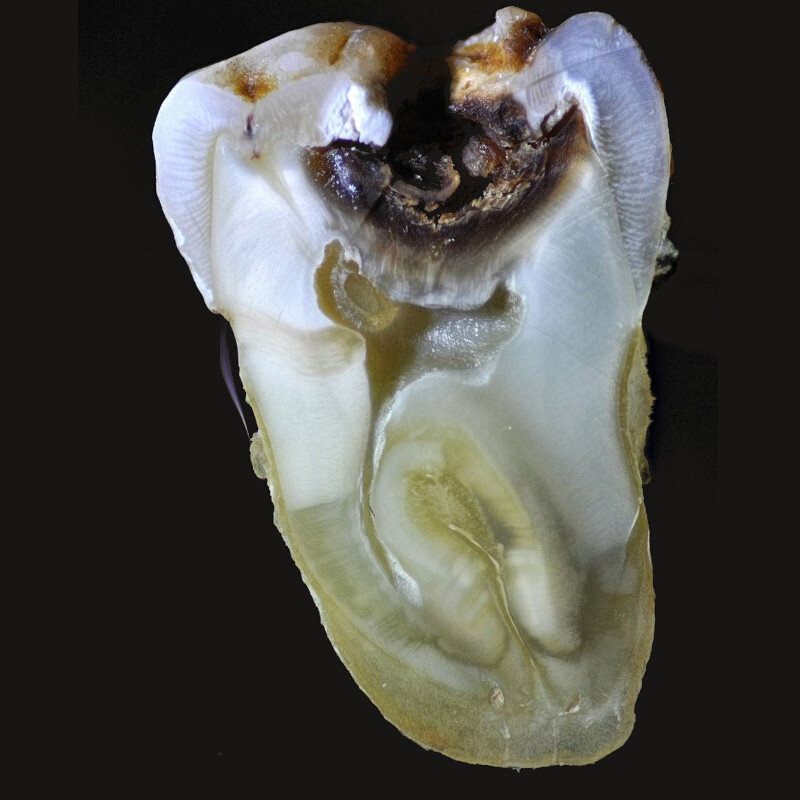 Зуб, в котором кариес дошел до нерва, распилен поперек.  Вот как это выглядит. Обратите внимание на размер полости в слое эмали и под ней.