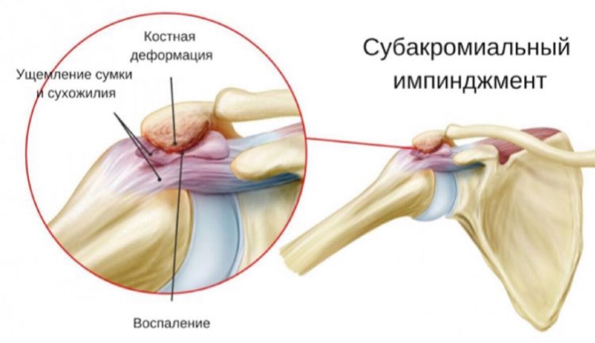 Импиджмент синдром плечевого сустава. Субакромиальный импинджмент-синдром плечевого сустава. Импиджмент синдром плечевого сустава механизм. Субакромиальное пространство плечевого сустава.