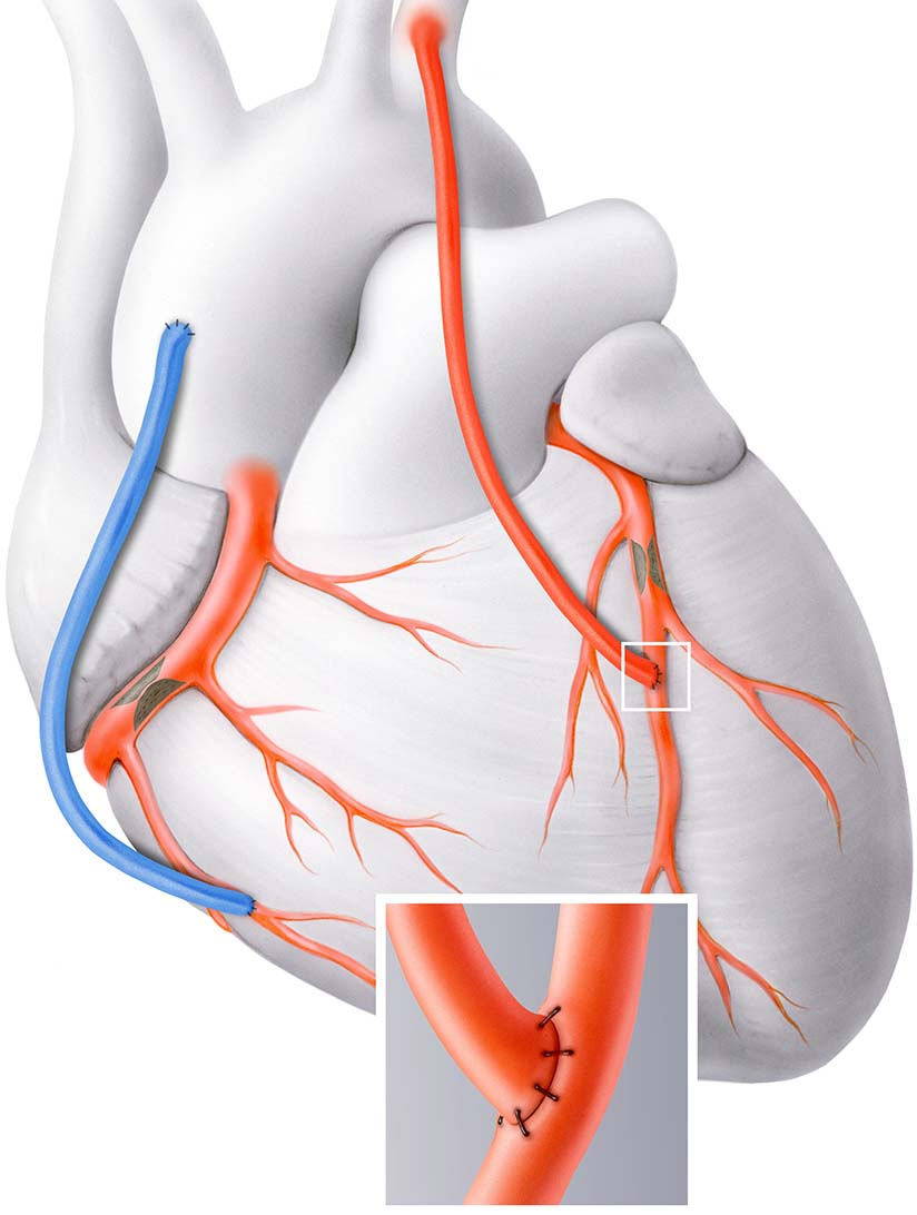 Лечение коронарных артерий. Маммарокоронарное шунтирование. Шунтирование коронарных артерий. Коронарное шунтирование сосудов сердца. Схема операции аортокоронарного шунтирования.