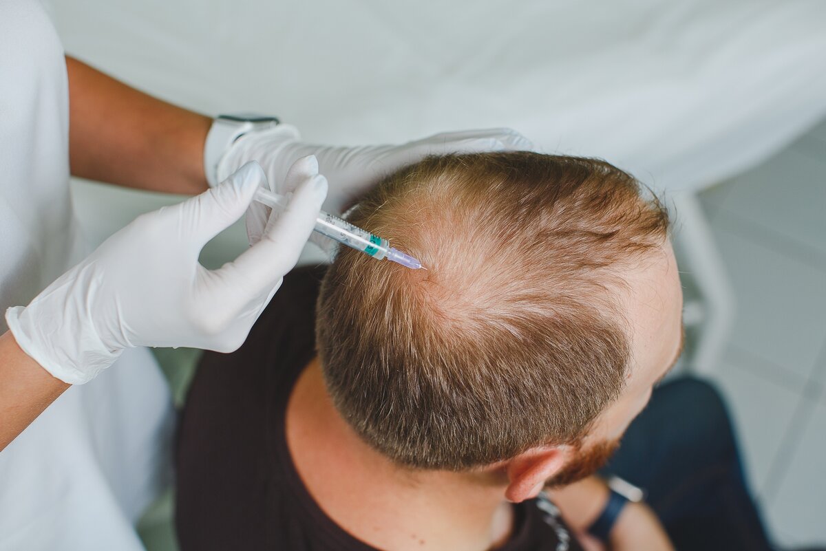 мезотерапия волосистой части головы. новое в лечении алопеции. к какому доктору идти с облысением. мезотерапия кожи головы. мезотерапия для волос мужчинам.