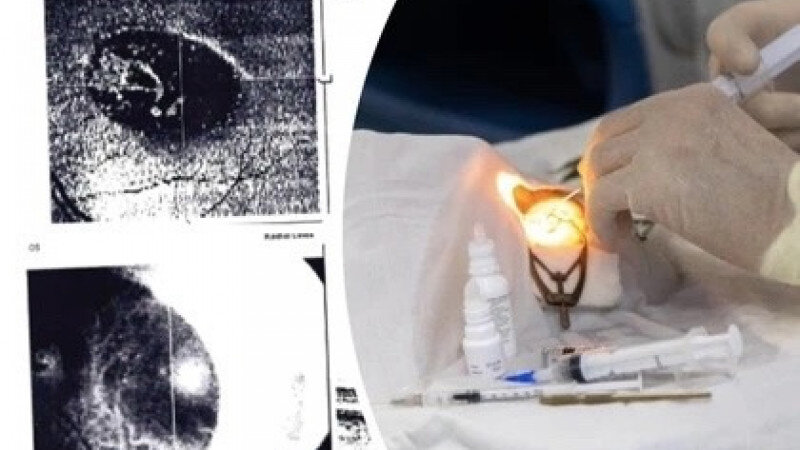     Пенсионерка судится с новосибирскими врачами из-за ампутации глаза КП Новосибирск