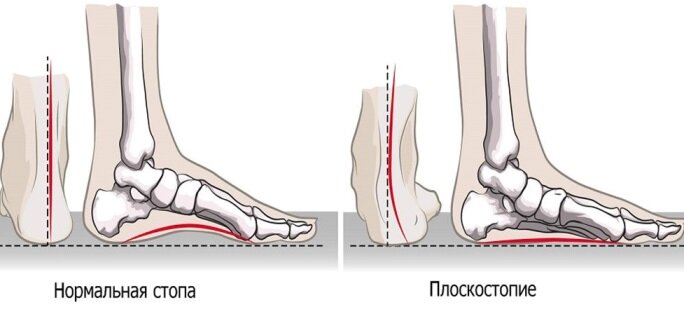 Плоскостопие наглядно