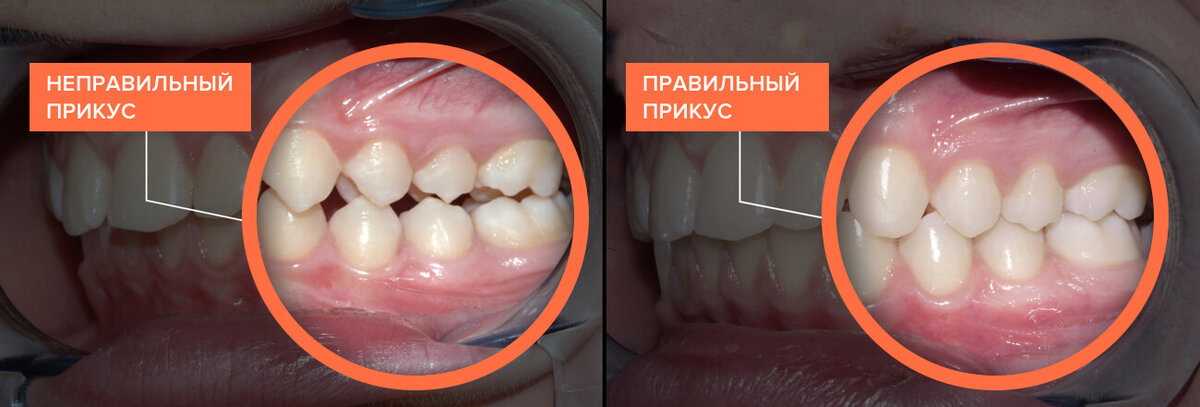 У ребенка растет зуб на десне: что делать и как исправить?