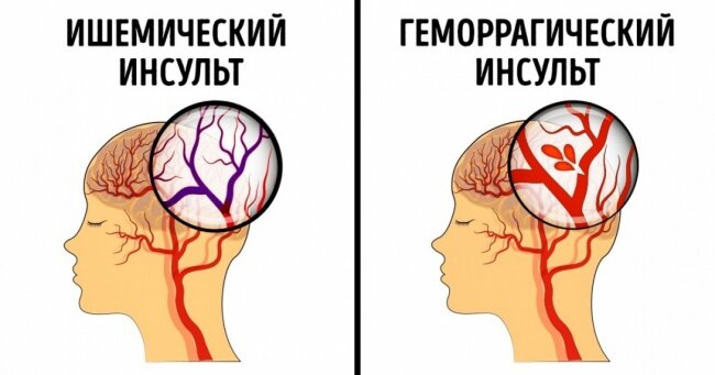 Виды инсульта.