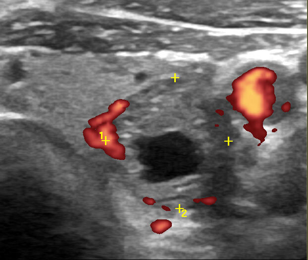 Как формально проводят УЗИ щитовидной или... врач не увидела узел. Случай из практики