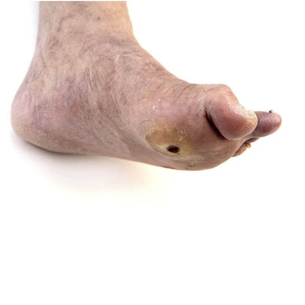 Визуально видно нарушение оттока венозной крови.Только операция.