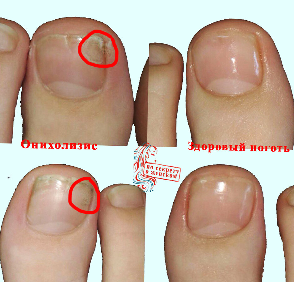 Онихолизис