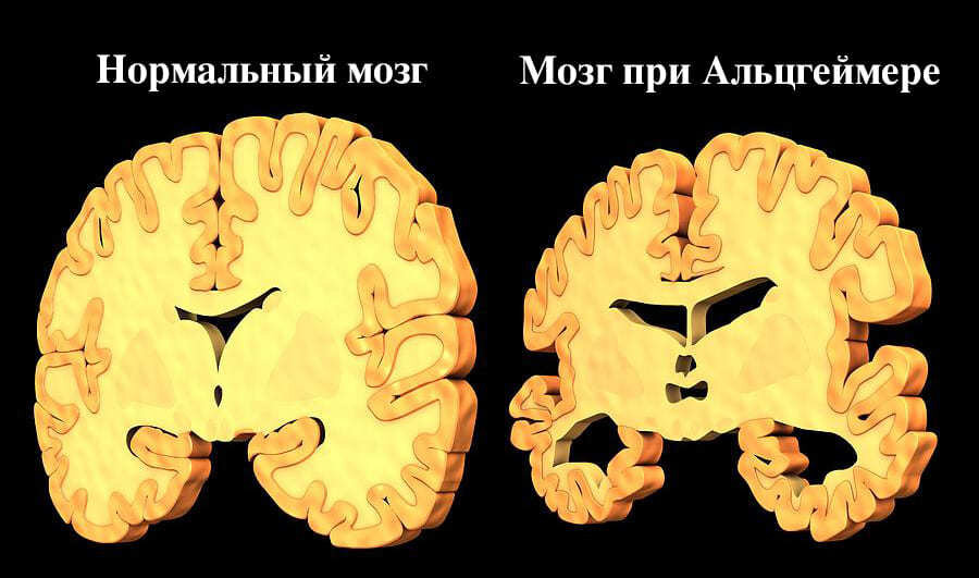 Верблюд на тесте альцгеймера. Мрт головного мозга при болезни Альцгеймера. Мозг Альцгеймера и нормального человека. Мозг человека больного Альцгеймером. Мозг при болезни Альцгеймера.