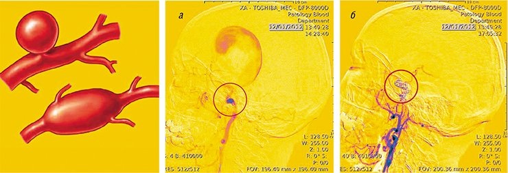 Артериальная аневризма представляет собой выпячивание стенки артерии вследствие ее растяжения (а). Один из способов «выключения» артериальной аневризмы из общего кровотока – заполнение ее упругими спиралями-койлами (б). Ангиограмма, СФБМЦ им. акад. Е. Н. Мешалкина