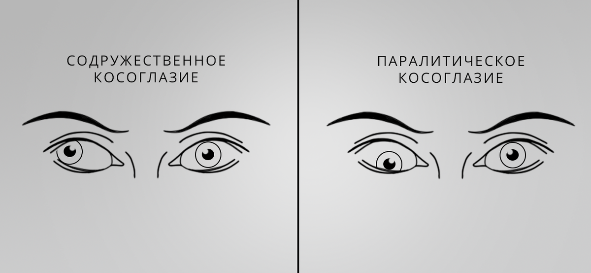 Косоглазие | Очкарик | Дзен