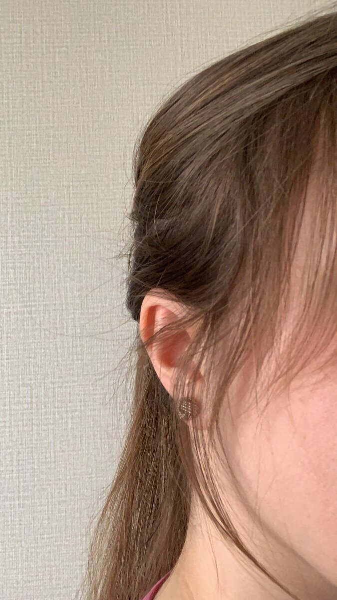 андрогенетическая алопеция. сильное выпадение волос. маленькие волоски на подбородке. гирсутизм и вирилизация. синдром кушинга гирсутизм.