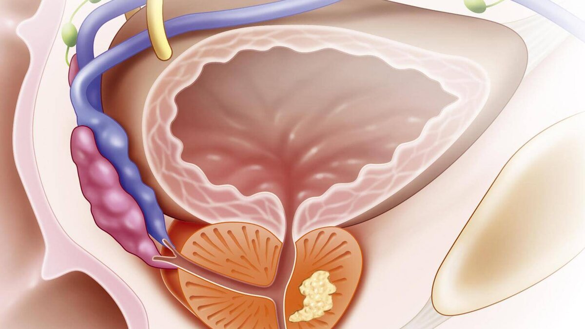Опухоль простаты у мужчин что это такое фото