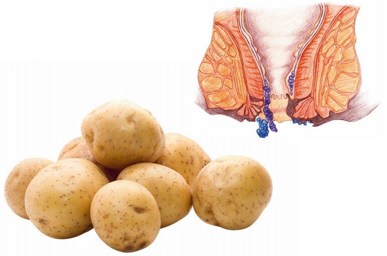 Лечение геморроя натуральными средствами: картофель