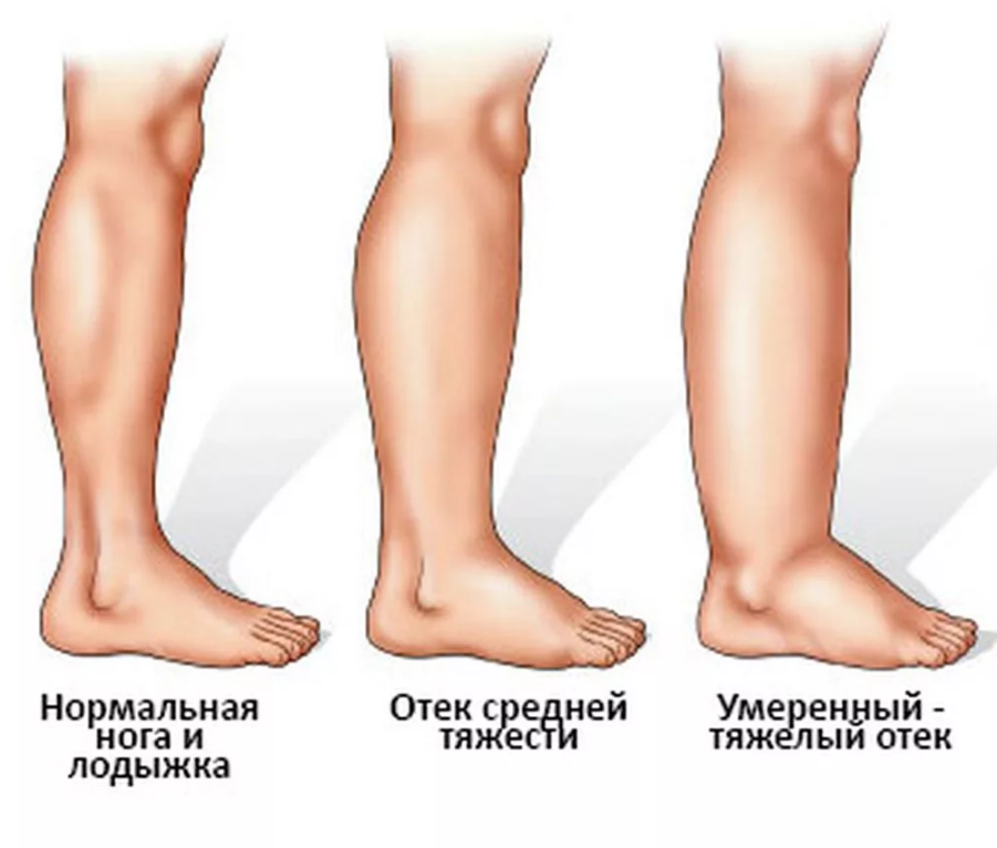 Почему болят ноги от колен до ступней