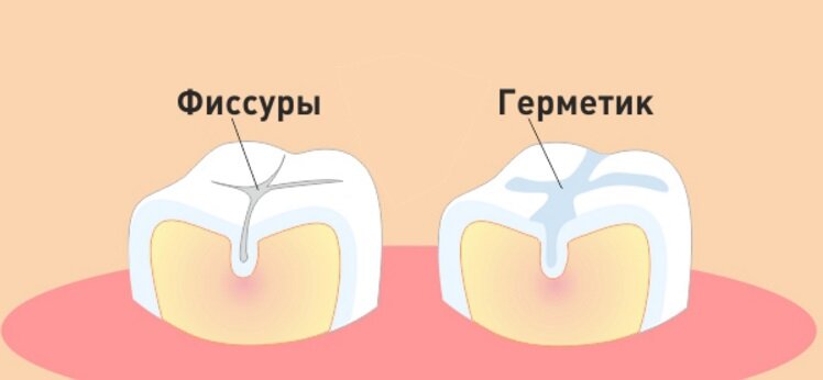 Фиссуры с герметиком и без