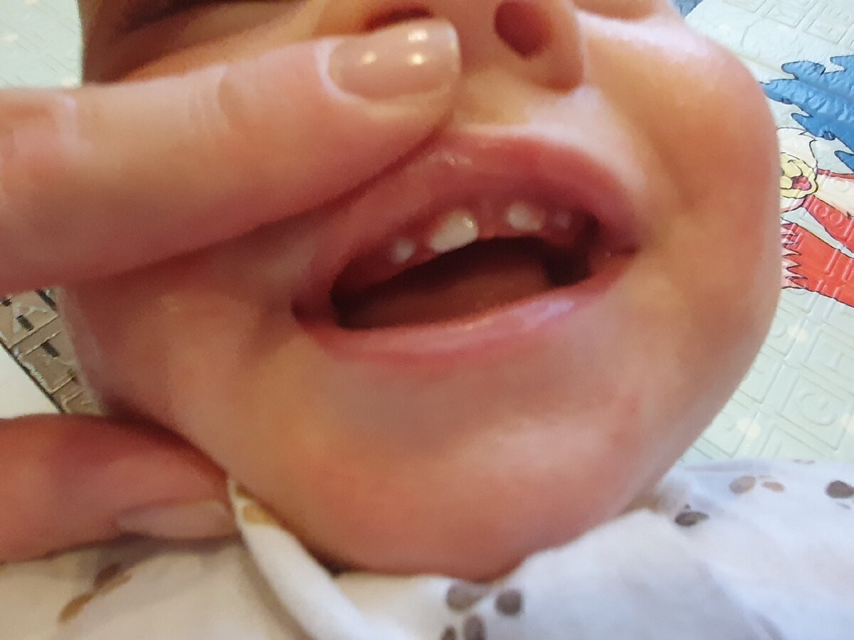 Наши 4 зуба!