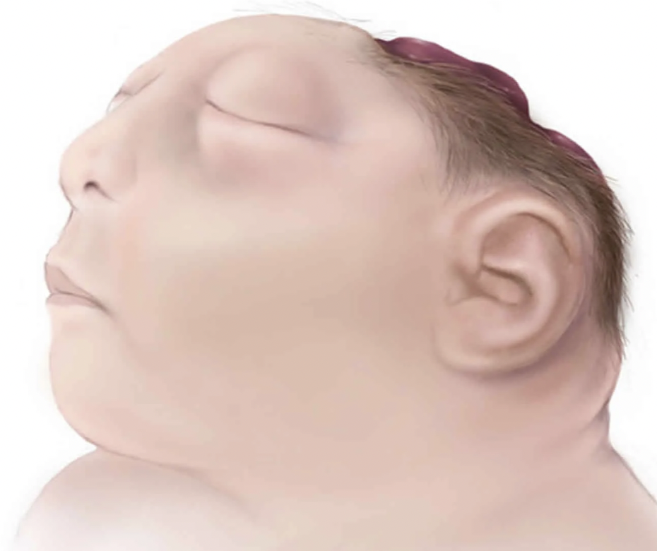 Рис. 2 - Анэнцефалия (др.-греч. ἀν- — без и ἐγκέφαλος — головной мозг) — внутриутробный порок развития плода.