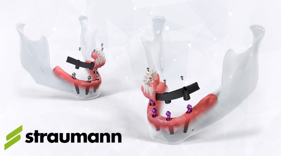 Одноэтапная имплантация – это восстановление в основном всех зубов на нескольких имплантатах за 1-3 дня. Один из таких методов – Pro Arch. Фотоколлаж: Smile-at-Once.ru.