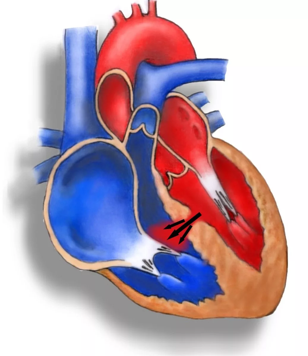 Аневризма перегородки у ребенка. ВПС межжелудочковой перегородки. Врожденные пороки сердца дефект межжелудочковой перегородки(ДМЖП). Межжелудочковый порок сердца. Дефект межжелудочной перегородки сердца.
