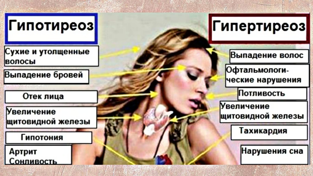 Напомню симптомы гипертиреоза и отличия от гипофункции щитовидки