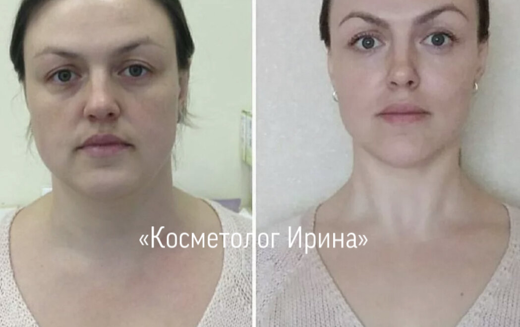Фотографии До и После «Косметолог Ирина»