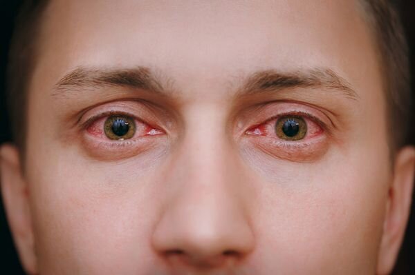 Покраснение глаз при кононавирусном конъюнктивите