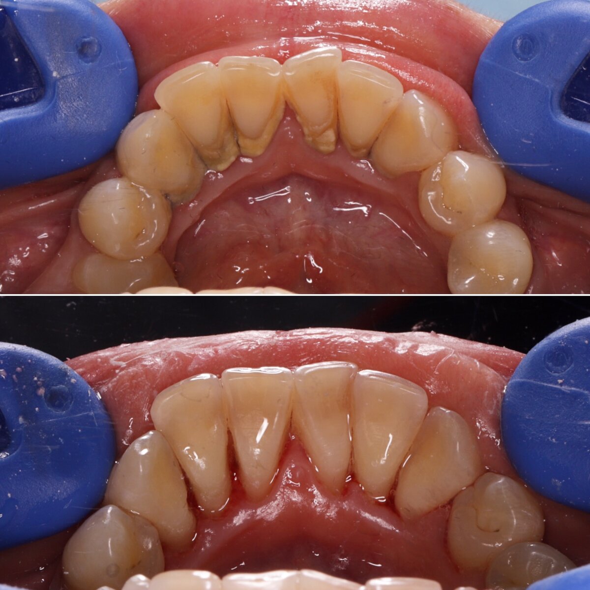 Зубной камень. Зубы до и  после профессиональной гигиены у стоматолога.