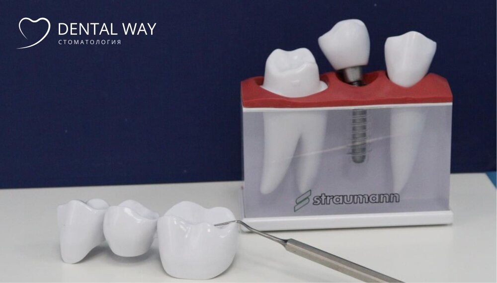 
Straumann - преимиальная линейка зубных имплантов, широко используемая стоматологами-имплантологами всего мира.

Что особенного в имплантах Straumann? Стоит ли переплачивать за премиальное качество? Есть ли недостатки у этих конструкций? Давайте разбираться.

О компании

Производитель имплантов Straumann начал свою деятельность в 1954 году в Швейцарии. На данный момент на счету компании более 9000000 успешно установленных имплантов, что составляет около 20% мирового рынка.

Компания не стоит на месте, и регулярно внедряет в работу инновационные методики и изучает процесс имплантации в собственной научной лаборатории.

Преимущества имплантов Straumann

Чем объясняется высокая стоимость этой системы имплантации? Чем премиальные импланты отличаются от имплантов эконом-сегмента?

	Уникальное покрытие имплантов

Покрытие SLActive, разработанное Straumann, позволяет импланту прижиться в рекордно короткие сроки - 3-4 недели. 

	Особое строение импланта

Наиболее уязвимой частью конструкции является соединение импланта - искуственного корня зуба и коронки - его видимой части. В этом месте могут скапливаться бактерии. 

При использовании имплантов Straumann место соединения остается на уровне десны, а не погружается в костную ткань, обеспечивая безопасность.

	Состав сплава

Импланты Штрауман производятся из чистого титана без примесей, что существенно снижает вероятность возникновения аллергической реакции и повышает процент приживления имплантов до 99,8%.

	Пожизненная гарантия на импланты

Компания уверена в качестве своих изделий, и поэтому предлагает бесплатную замену импланта в случае возникновения проблем.

Недостатки имплантов Straumann

Основной недостаток имплантов Straumann - достаточно высокая цена в сравнении с аналогами. Однако, стоит понимать, что вложение в свое здоровье точно окупит себя годами комфортной жизни.

Кроме того, работа с имплантами Straumann требует дополнительного обучения. Не каждый стоматолог-имплантолог умеет работать с этой системой.

Процесс установки имплантов

Все начинается с диагностики. По снимку компьютерной томографии доктор определяет возможность установки импланта без наращивания костной ткани, подбирает подходящий размер, форму и диаметр импланта.

Операция по установке импланта абсолютно безболезненна, проводится под местной анестезией и занимает около 20 минут. 

После делается еще одна компьютерная томография: врач должен удостовериться, что имплант установлен правильно.


