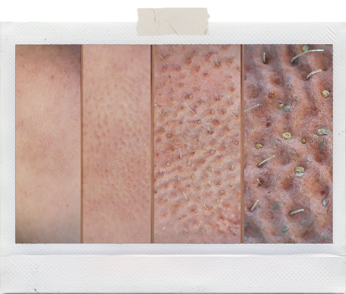 Поры на коже лица с постепенным увеличением через микроскоп 