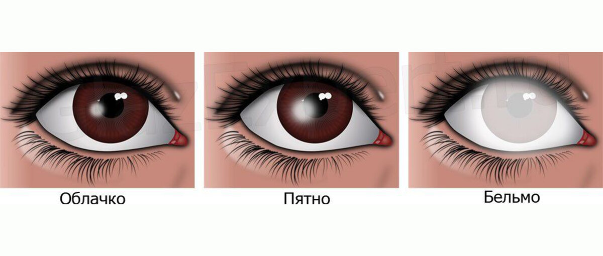 Как бельмо на глазу значение фразеологизма. Васкуляризированное бельмо роговицы офтальмология. Фразеологизм как бельмо. Как бельмо на глазу значение фразеологизма. Бельмо это в переносном смысле.