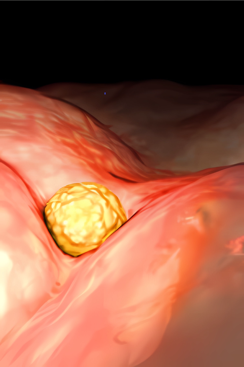 Неделя 04 - Имплантация яйцеклетки в стенку матки.