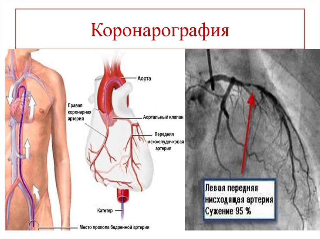 Коронарография сосудов сердца фото