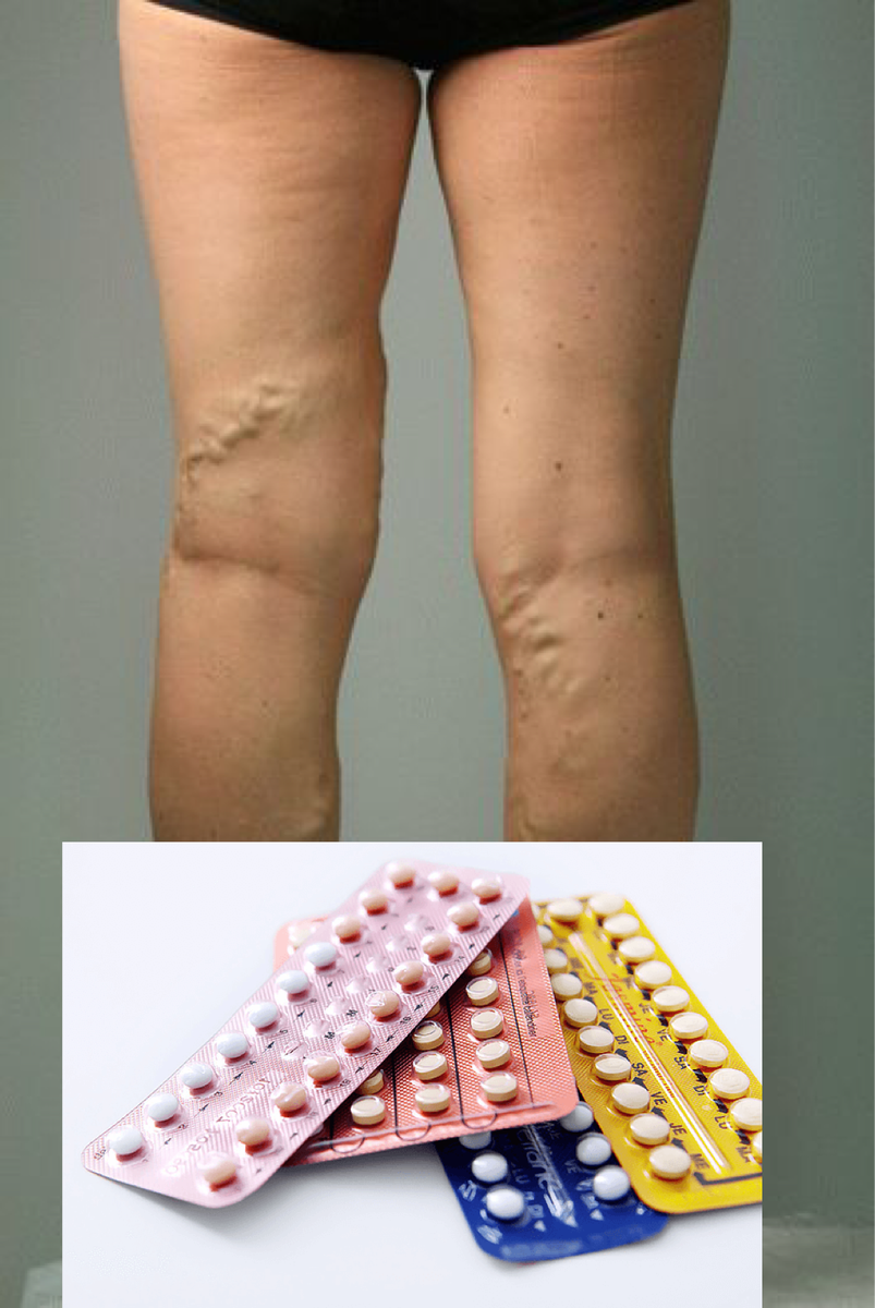 
Частый и очень актуальный вопрос, который задается как флебологам, так и гинекологам: « У меня варикоз, а можно ли мне пить противозачаточные.» 
Давайте разберем по порядку.
Если внимательно читали аннотацию к лекарству, написано, что с осторожностью принимать при варикозе, а при наличии  тромбозов и тромбофлебитов противопоказано вообще.
И как быть?🤔 Гинеколог настаивает на приеме таблеток.
В настоящее время врачи гинекологи все больше и больше рекомендуют перед началом приема контрацептивов дообследоваться.  Но ☝️, если, этого не сделали, обследуйтесь сами. 
С чего начать:
👉при наличии варикоза перед началом приема контрацептива необходимо пройти УЗИ вен на ногах и проконсультироваться с флебологом.
Если есть  варикоз настоятельно рекомендуются убрать измененные вены, и только потом начинать прием контрацептивов. 
👉 если нашли тромбоз, тромбофлебит - однозначно нет, посттромботическую болезнь - вопрос будет решаться по жизненным показаниям, что важнее. Но, ☝️как показывает практика, препараты отменяются.
👉если по результатам анализа крови выявляется генетическая предрасположенность к тромбозам, вопрос о приеме препаратов решается индивидуально. 
А, если уже начали принимать препарат 🤭 или отложить их прием было нельзя, обратиться к флебологу все же нужно. И убрать варикоз, при его наличии тоже обязательно. На период лечения прием препарата продолжается по схеме, назначенной гинекологом. 

А, если варикоза нет? 🧐Обязательно ли обследоваться перед началом приема противозачаточных таблеток?
Однозначно - ДА. ☝️Необходимо пройти УЗ обследование и сдать анализ крови  на генетическую предрасположенность к тромбозам. И если по результату анализа крови выявиться хоть одно изменение в генетике, препараты пить  не рекомендуется, т.к. возрастает риск развития тромбоза вен на ногах, и как следствие ТЭЛА( тромбоэмболии легочной артерии).
 Будут вопросы пишите!
