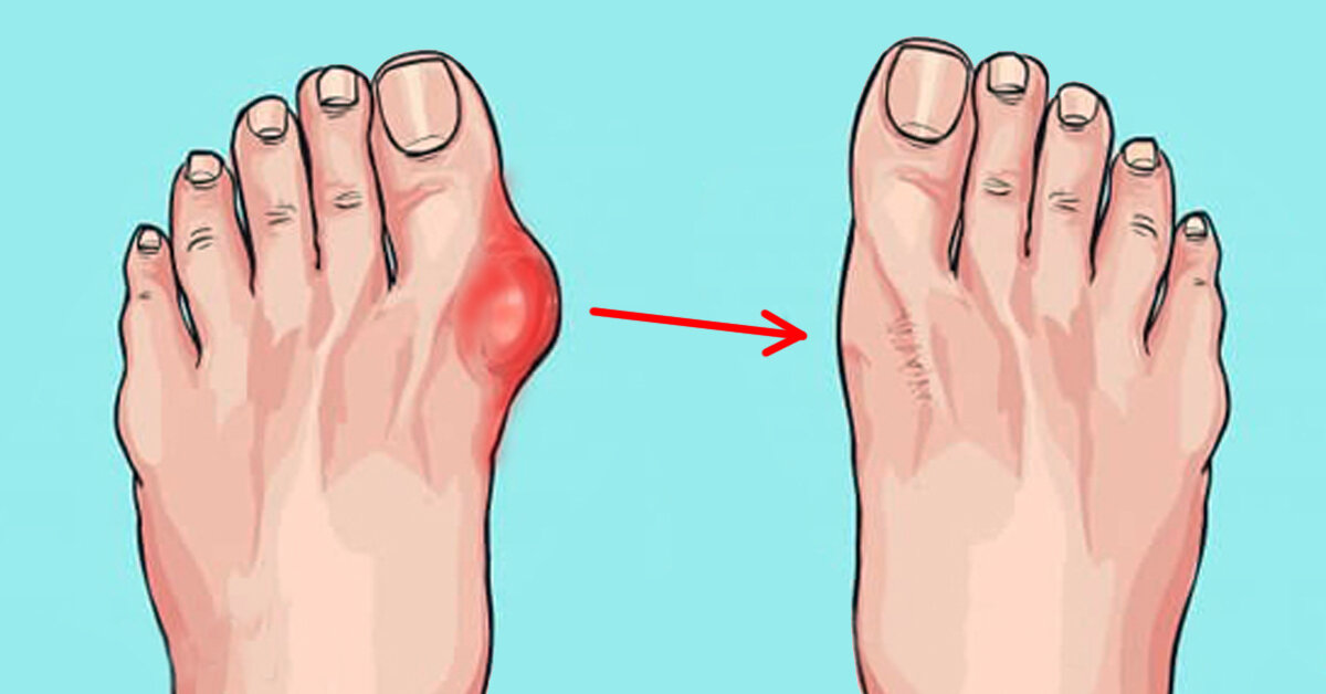 Как избавиться от шишек на ногах, пальце и пятке