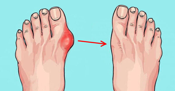 6 основных причин, почему появляется шишка на ноге