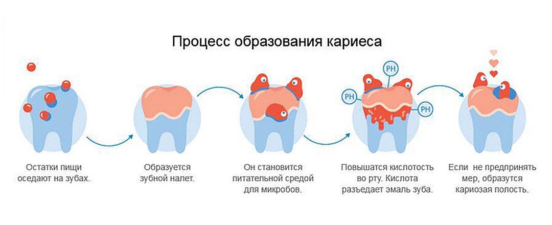 Рассмотрите рисунки 1 4 с изображением зуба человека как называется заболевание зуба стадии развития