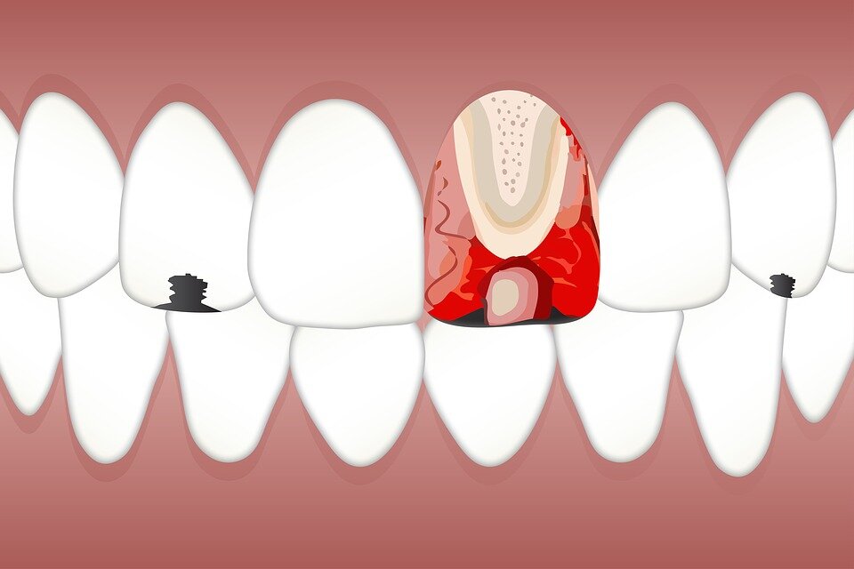 Как заживает лунка после удаления зуба