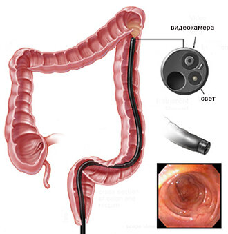 Колоноскопия