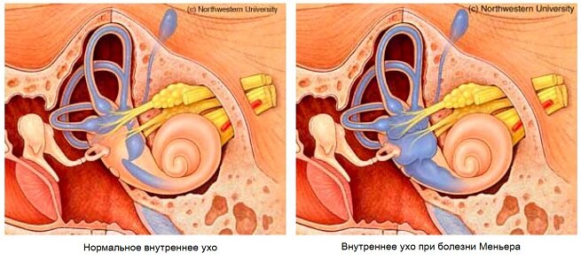 [caption id="attachment_1706" align="aligncenter" width="655"] Внутреннее ухо с болезнью и без[/caption]