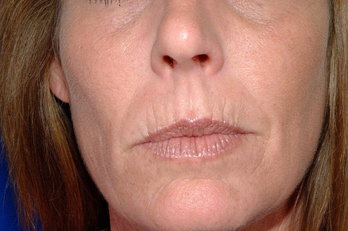 На фото кисетные морщины 