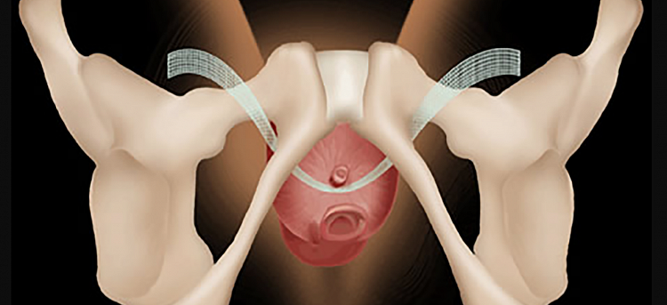 Принцип действия слинговой петли