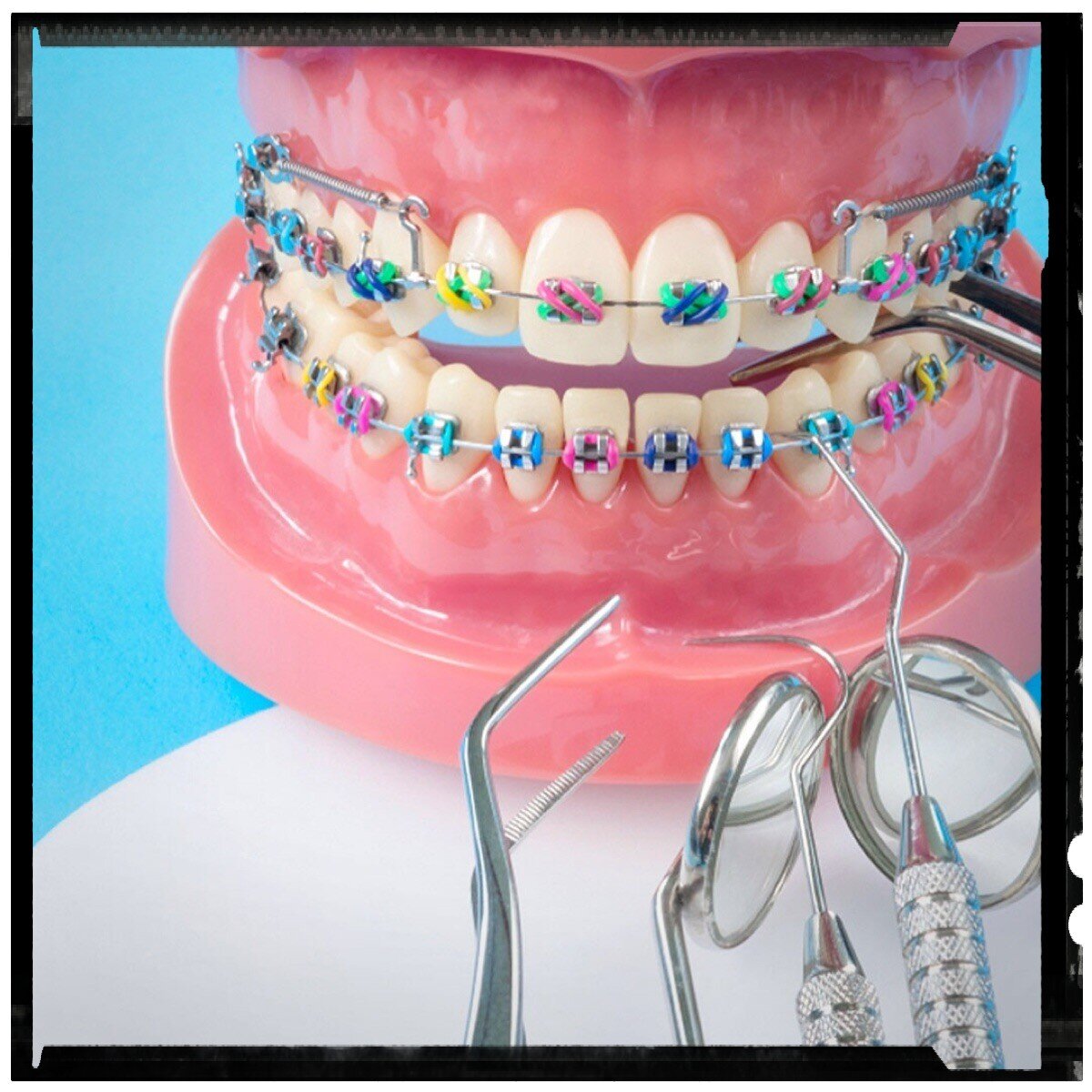 Брекет система