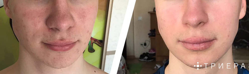 Результат лечения пациента Эксперт-Клиники "Триера" в Краснодаре