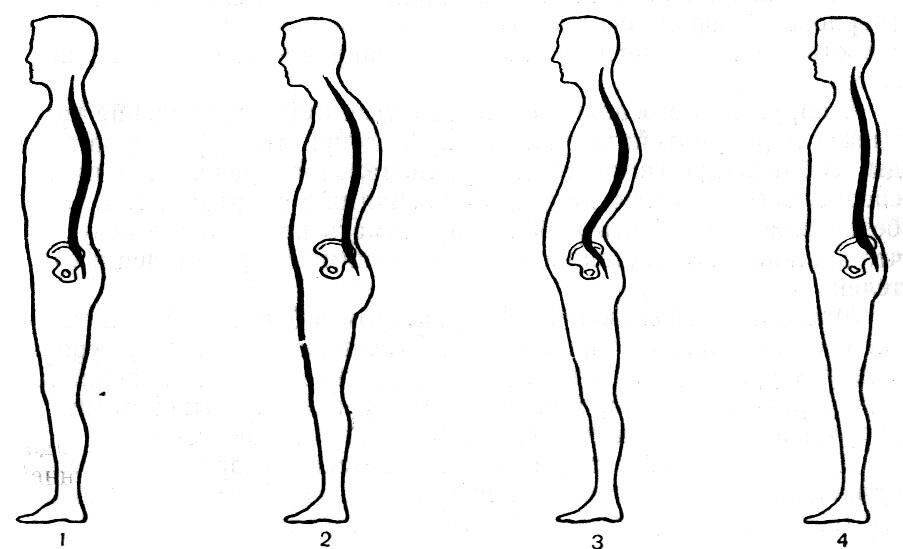 виды осанки (сокращенная версия) //фото взято из интернета//